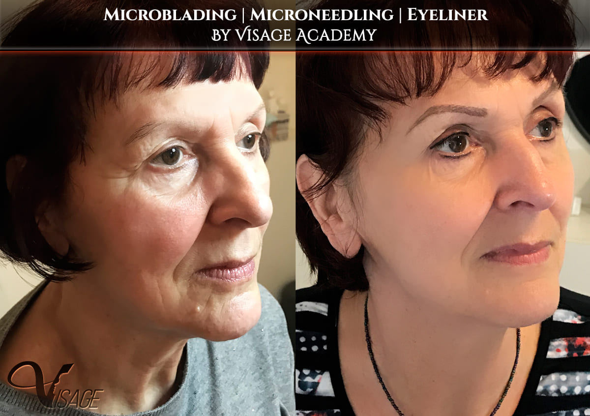 Microneedling Schulung In Wien Linz Graz Salzburg