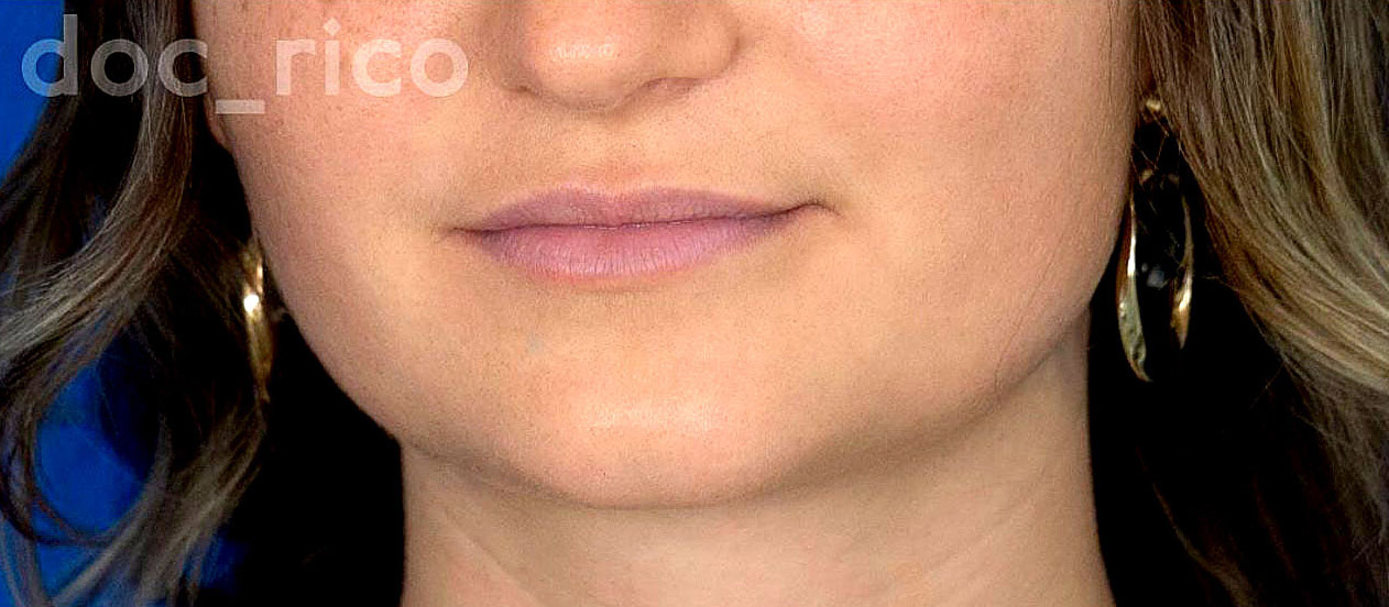Vor der ersten Visage Hyaluron Pen Behandlung