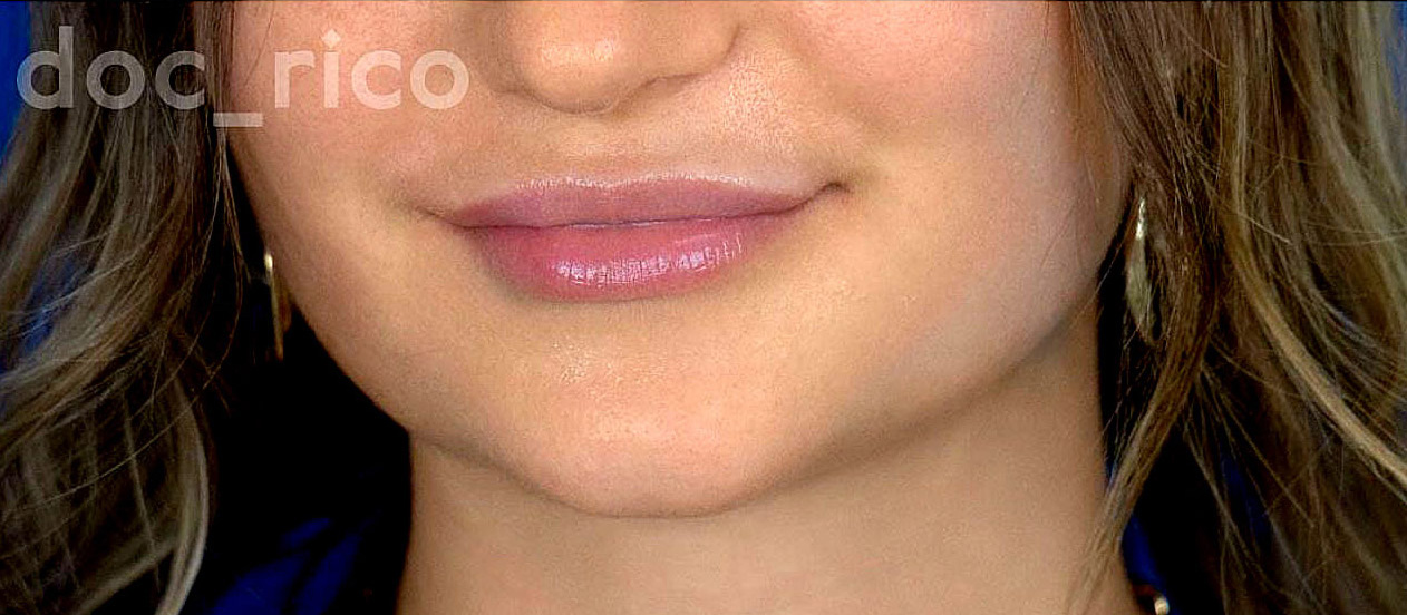 Direkt nach der ersten Visage Hyaluron Pen Behandlung mit 1,1 ml