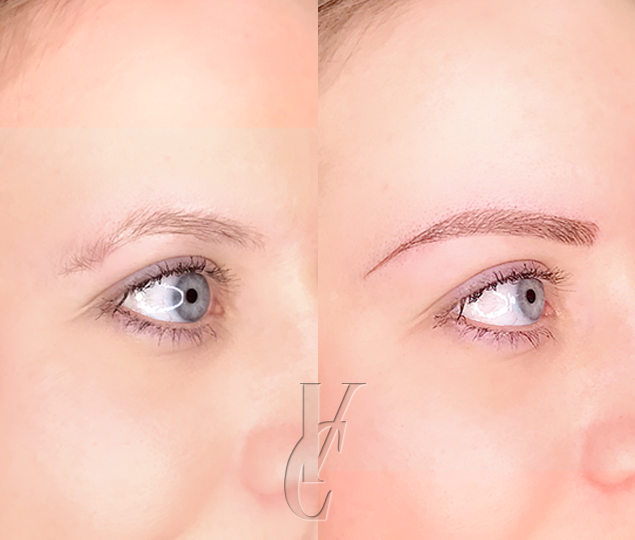 Kollagenbildung durch Carbon Hollywood Peel